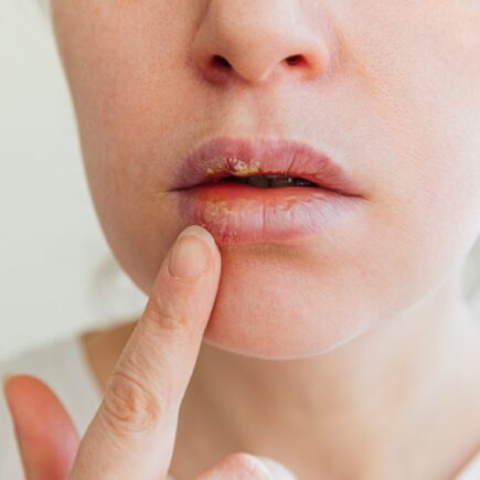 herpes na ústach
