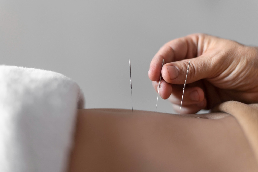 akupunkturista robí akupunktúru pomocou vpichovania ihiel